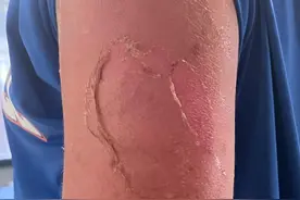 海边游泳2小时，长沙11岁男童被晒伤！医生提醒图片