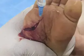 一5龄童在泳池被碎瓷砖划伤脚缝了10针 文体局：停业整改图片