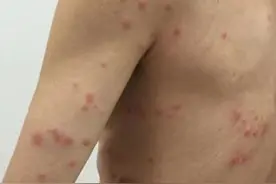 男子全身起红疹奇痒难忍，竟然是它在作怪图片