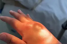 前方高能！女子的手被蚊子咬出个“馒头包”……图片