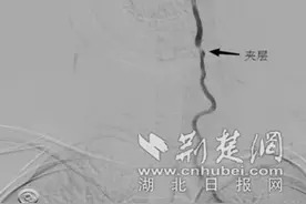 盛夏体验漂流竟引发“中风” 32岁女子险丢性命图片