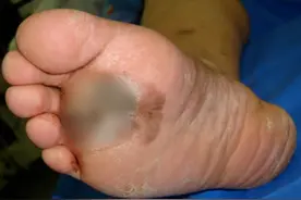 只因“手欠”抠破黑痣变成癌？劝你不要做这4个做法→图片