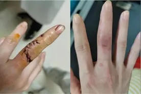 肌腱断裂！术后手指僵硬，医生妙手帮助她恢复手功能图片