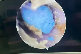 危险！4岁孩子模仿孙悟空，把“金箍棒”塞进耳朵图片