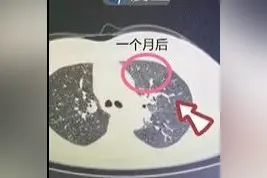 肺癌术后一年又现阴影！竟是“吃出来的”？图片