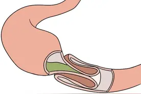 儿童肠套叠：不容忽视的肠道“叠叠乐”图片