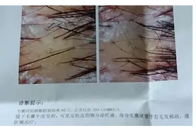 头油头痒，竟然需要去医院做检查？头上长了这种虫卵要当心！图片