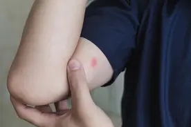 转发！被蚊子咬了能迅速止痒的4个方法图片