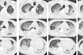 84岁大爷口吐白沫，双肺都白了！竟是大冬天中暑图片