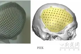 湖北航天医院神经外科：颅骨修补术重塑患者完整头型图片