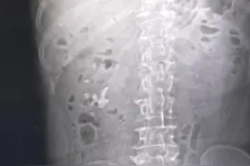 12岁少年患肾结石敲警钟！科学饮食调理成防石关键图片