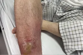 广东一男子腿“烂”到直流脓！医生提醒：夏天做这些事，要当心图片