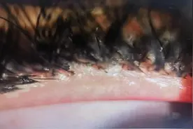 种睫毛“种”下眼疾：杭州有医院年前接诊十余例年轻女患者图片