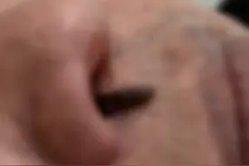 头皮发麻！男子反复流鼻血，医生竟取出一条活的…图片