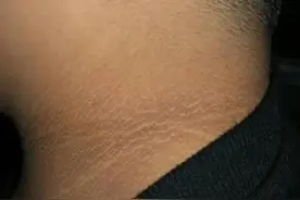 孩子脖子黑洗不净，竟然是这个病的“前奏”图片