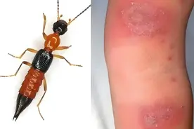 【汤医科普】警惕“飞行的皮肤杀手”图片