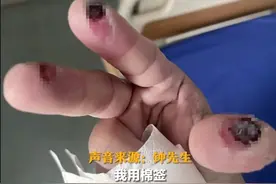 不小心碰到，男子三根手指烂出黑洞！最近很多人使用图片