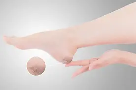 脚后跟总干裂的人，可能是感染了这种“真菌”！图片