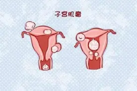 子宫肌瘤要不要手术？松江医生为你科普丨健康智慧屋图片