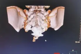 13岁女孩留置导尿超10年，机器人辅助手术摆脱排尿困扰图片
