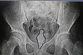 危险！12岁男孩紧急就医，青大附院小儿外科医生手术取出160颗磁力珠图片