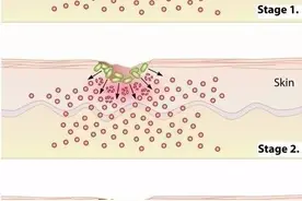被小龙虾刺了下，大伯人没了！这种病近期高发图片