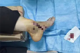 最担心的事还是发生了！资深滑板玩家挑战高难度动作骨折入院，专家提醒图片