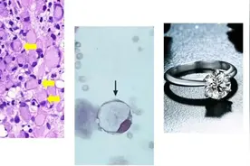 女子呕血3天一查竟患“癌王”！这5种症状要注意图片