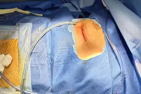 心脏有“漏洞”，微创巧“封堵”丨滨州市中心医院成功治疗一例巨大房间隔缺损患者图片