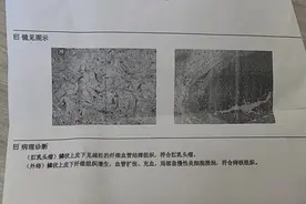 长达10厘米！肛周长出的“小尾巴”，竟不是痔疮是肛乳头瘤图片