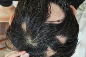 “我的头发还能长回来吗？”32岁小伙“秃”然变大叔图片