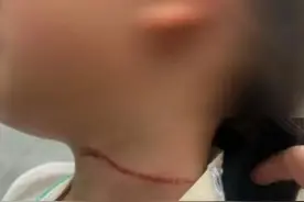 7岁女孩遭风筝线割脖受伤！警惕“无形的刀”！图片