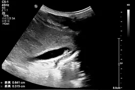 深圳13岁男孩反复低烧一个星期 原因竟是爱吃这种食物图片