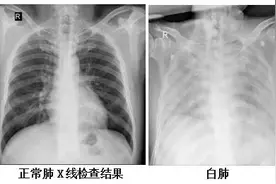 女子硬扛流感10天肺都白了！“白肺”有多危险？能治愈吗？图片