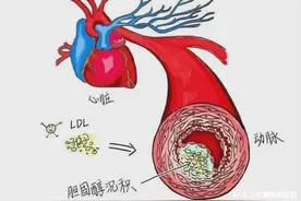 【杨柳血管智汇】血管外科：你的血管还好吗？识别外周血管疾病的那些信号图片