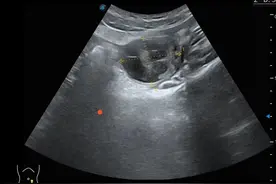 11岁女孩突然遭遇黄体破裂，医生提醒：出现这些情况要当心图片