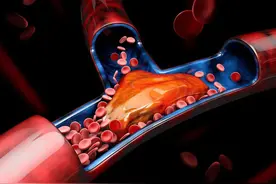 血栓最易堵在三处图片