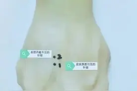 扎针后明明不出血了，为什么会青紫？图片