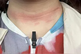 95后姑娘骑车途中遭“割喉”，当心这个隐形杀手图片