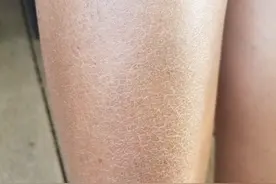 破案了！一到秋冬小腿就瘙痒难耐，其实是一种病图片