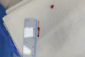 拆除体内游走的“炸弹”：患儿留置针导管断裂后，漫长的求医路图片