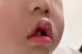 男童不慎把502胶水抹嘴巴胳膊上，网友纷纷出招！正确处理方法来了图片