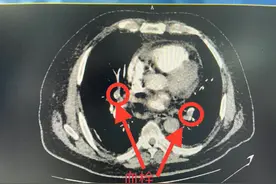 长沙爹爹就医路上晕倒，住进ICU！这些人群易被肺栓塞“盯上”图片