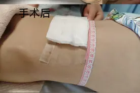 因一种先天性疾病，男孩13年来腹胀便秘；手术为其重建肠道功能图片