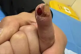 孩子都爱“吃手手”？有娃把手指“啃”断了！图片