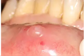 科普口腔丨口腔黏膜上的“小泡”图片