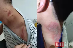 毒液堪比硫酸！医生提醒：这种虫子飞到身上千万别拍打图片