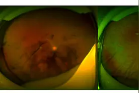 得了糖尿病，眼睛却失明？专家提醒糖尿病患者要定期检查眼底图片