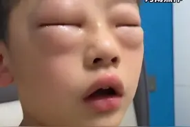 男孩每天双眼发肿，原来是……图片