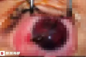 事发泉州！女童拆快递时不慎刺伤眼 画面触目惊心图片